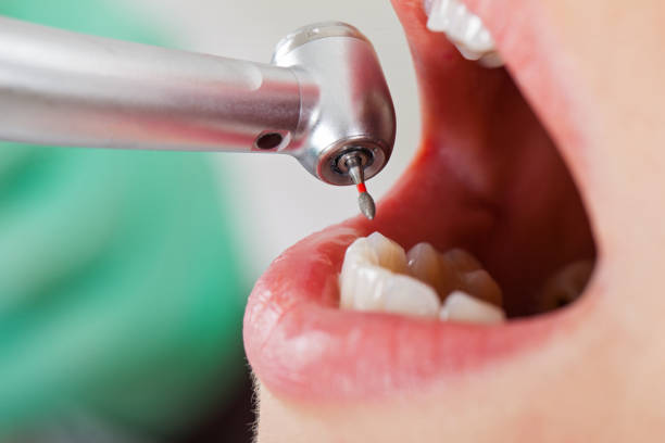 Best Emergency Dental Care for Broken or Chipped Teeth in Charlestown, MD